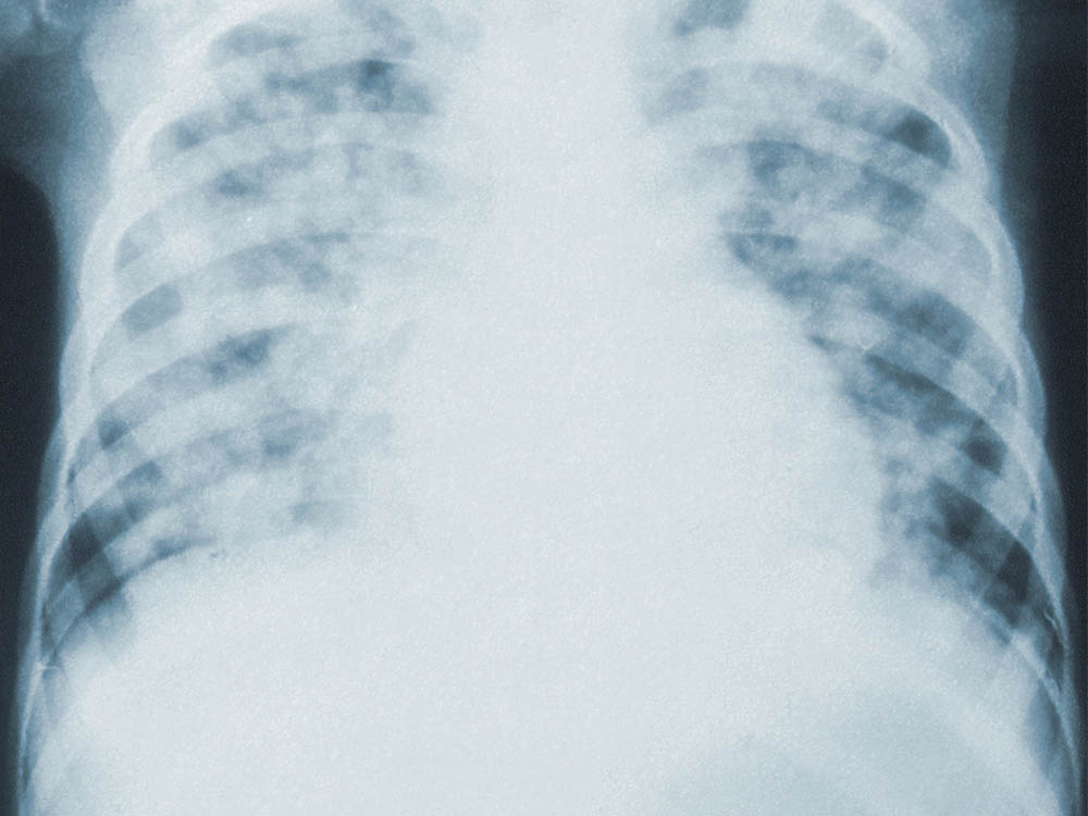 Показания к рентгенологическому исследованию легких