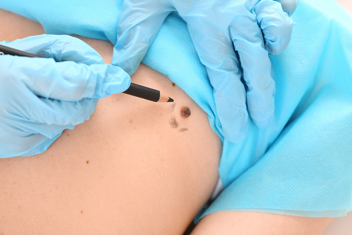 Лучевая терапия базалиомы-5