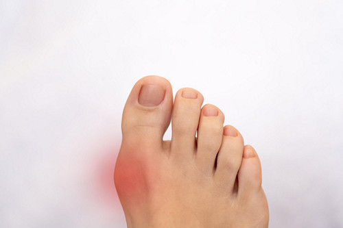 Лечение подагры - фото 3