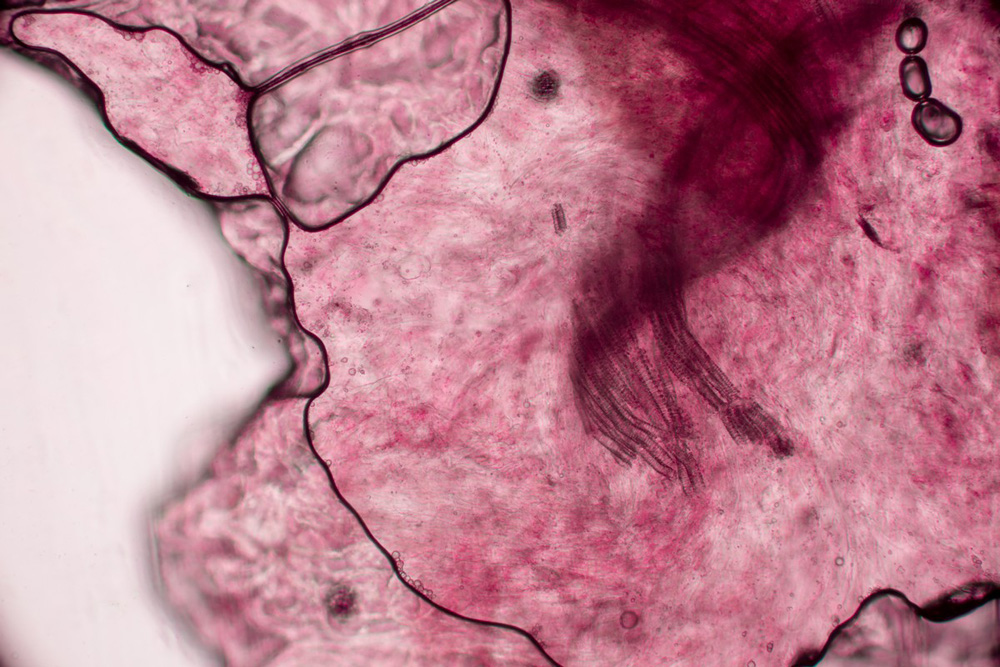 Склеродермия : симптомы, лечение, профилактика