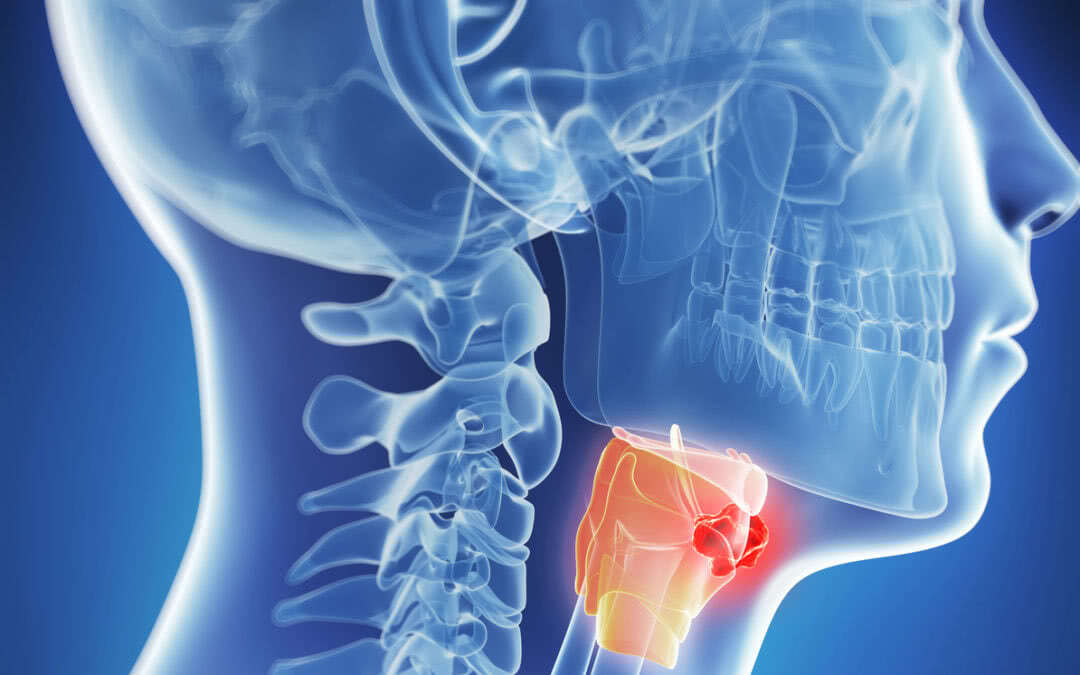 Рак органов головы и шеи