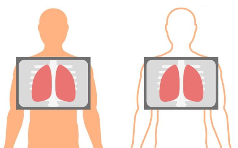 Рентген или флюорография легких?